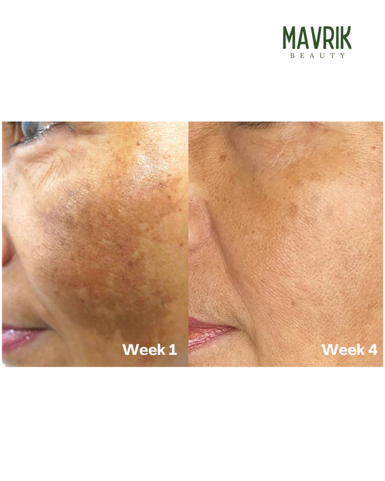 Aboriginal Turmeric & Kojic Acid Brightening Soap – Erases Dark Spots & Scars Fast