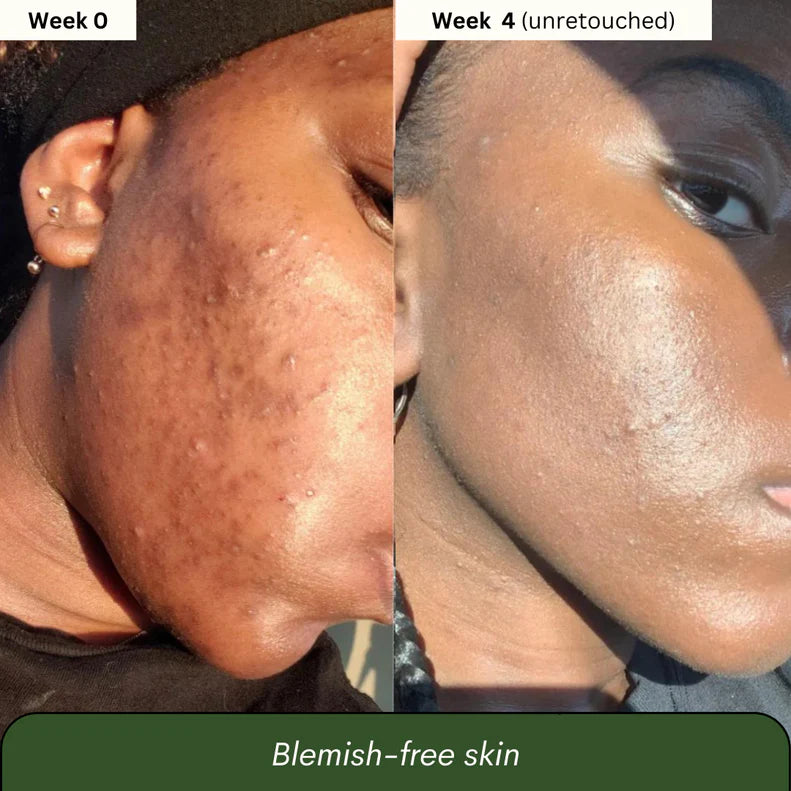 Aboriginal Turmeric & Kojic Acid Brightening Soap – Erases Dark Spots & Scars Fast