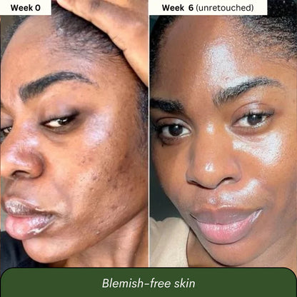 Aboriginal Turmeric & Kojic Acid Brightening Soap – Erases Dark Spots & Scars Fast