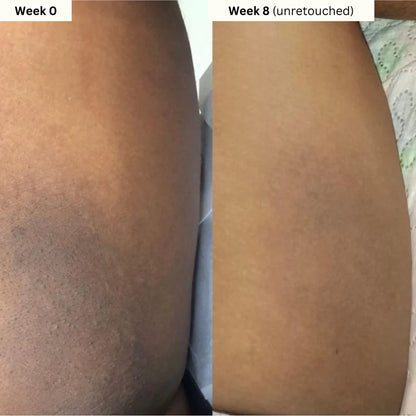 Aboriginal Turmeric & Kojic Acid Brightening Soap – Erases Dark Spots & Scars Fast