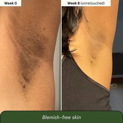 Aboriginal Turmeric & Kojic Acid Brightening Soap – Erases Dark Spots & Scars Fast