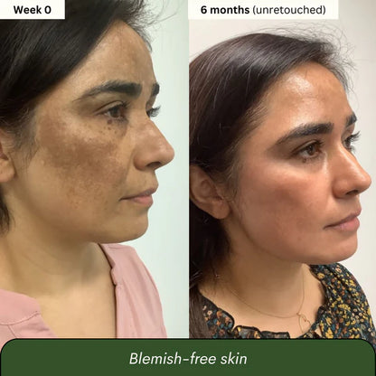 Aboriginal Turmeric & Kojic Acid Brightening Soap – Erases Dark Spots & Scars Fast