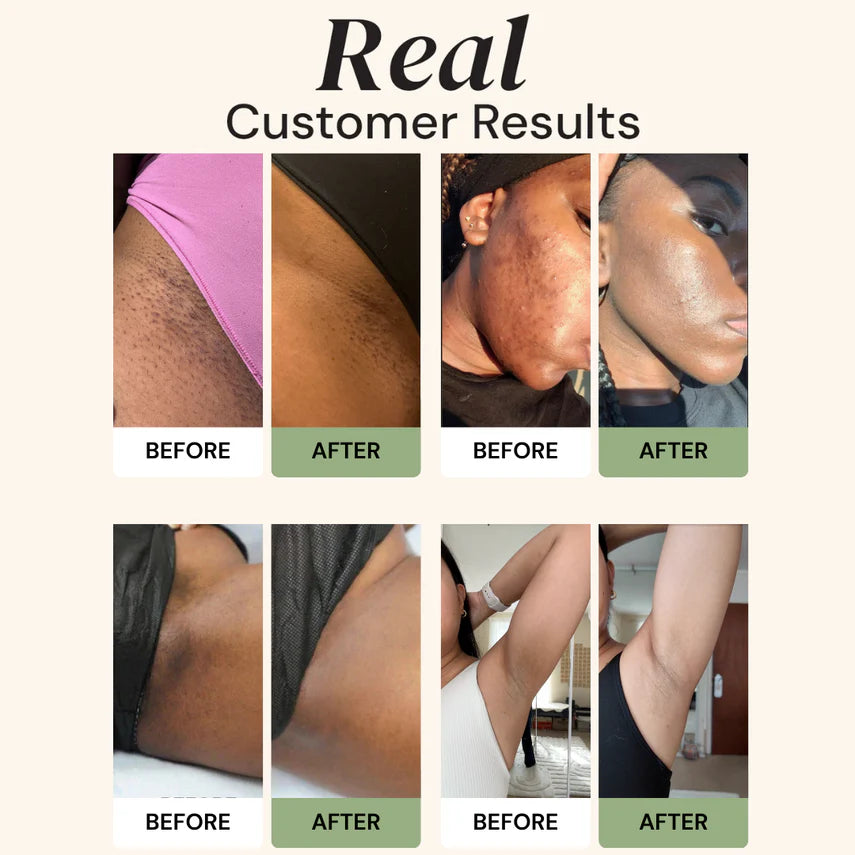 Aboriginal Turmeric & Kojic Acid Brightening Soap – Erases Dark Spots & Scars Fast